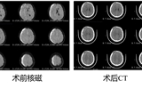 蘭大二院成功完成鎖孔入路聯(lián)合神經(jīng)內(nèi)鏡術(shù)治療慢性硬膜下血腫（CSDH）患者